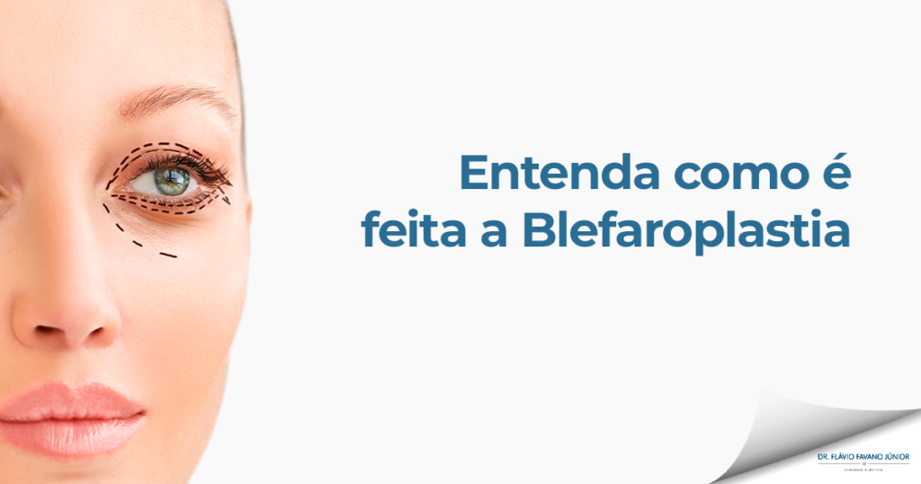 mulher que vai passar pela blefaroplastia