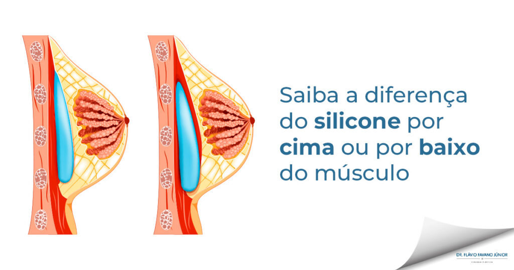 Ilustração mostrando um seio com a prótese de silicone na frente e outra atrás do músculo