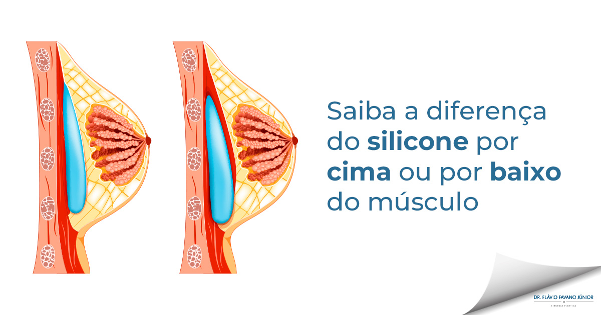 Prótese de silicone: por cima ou por baixo do músculo?